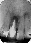Fig 1. Radiographic image of failing tooth No. 9.