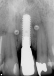 Fig 17. Radiographic image of after final crown insertion.