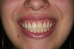 Fig 1. Existing condition, high smile line, thin biotype, and tapered tooth form.