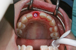 Fig 5. Ideal implant placement with buccal gap.