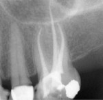 Figure 1   A maxillary first molar obturated with Resilon Epiphany/RealSeal.