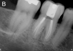 Figure 2  A mandibular first molar obturated with ActiV GP cones and ActiV GP sealer. (Courtesy Dr. Ali Allen Nasseh, Boston, MA.)