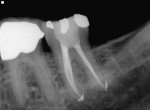 Figure 5  A mandibular second molar obturated with RealSeal 1 carriers in each canal and RealSeal sealer. (Courtesy of Dr. Joseph D. Maggio, Lisle, IL.)</div>