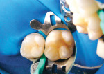 Figure 1  Apply rubber dam and insert the specially designed dental wedges to slightly separate the teeth.