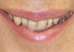 Figure 1  Preoperative photographs. The patient felt self-conscious about her smile and wanted them straighter and whiter. Note the anterior crowding and very prominent maxillary right canine.