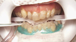 Figure 16  The patient’s lower teeth were isolated and whitened in three rounds of 20-minute sessions using a 25% hydrogen peroxide gel without a light source. She was then given a custom lower whitening tray to be worn at night for 2 weeks wit
