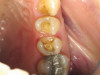 Fig 27. Seventeen-month follow-up showing keratinized gingiva at the free gingival margin, resolution of the recession defect and deepening of the vestibule. Fig