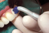Fig 29. Two adjacent implants placed in the esthetic zone can lead to loss of the interdental papilla and a negative outcome for a patient with a high smile line.