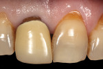 (2.) Intraoral view of tooth No. 8 with exposure of the restorative margin of the metal-ceramic crown. The color difference of the tooth structure between the two central incisors was evident.