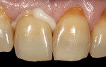 (14.) After final shade correction and patient approval, the final crown was cemented with a dual-cured resin cement. The internal zirconia surface was cleaned prior to primer application.