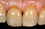 (16.) Intraoral view of the completed final crown No. 8, 1 week after definitive cementation. Note the positive soft-tissue response to the well-adapted crown.