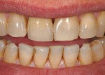 (17.) Extraoral frontal smile view of the definitive crown restoration.