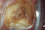 (3.) Clinical aspect after removal of the provisional restoration.