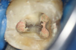 (6.) Canals obturated with gutta-percha cones and Fillapex MTA.