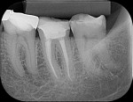(8.) Control X-ray after 17 months.