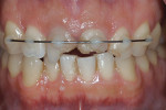 (3.) Frontal intraoral view upon first examination.