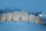 (7.) Frontal intraoral views of the final composite restorations.
