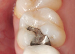 Figure 1  Failing amalgam in tooth No. 3.