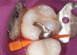 Figure 2  Pre-wedging provides excellent separation which results in tight interproximal contacts.