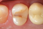 Figure 1   A preoperative occlusal view of tooth No. 12. Recurrent decay and marginal leakage existed, requiring that the defective restoration be replaced.