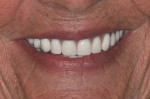 Fig 18. The patient’s smile post-treatment.