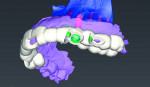 Fig 3. Surgical guide design in the implant planning software.