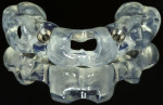 Fig 7. 3D surgical drilling template.