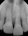 Fig 2. Periapical radiograph demonstrating severe bone loss and widened periodontal ligament. Limited bone available between the apex of the tooth and the nasal floor.