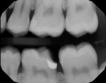 (7.) Completed margin elevation with perfect marginal seal. Mesial caries treated separately at cementation appointment. For an indirect restoration, the final impression will be taken now.