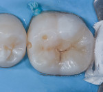(9.) Cementation of inlay, access of mesial caries. Mesial lesion is restored separately to conserve valuable intact tooth structure.