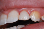 (2.) Immediately after placement of full resin-based composite crown.
