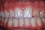 (3.) 30 months postoperatively, the crown appears yellow after patient used bleaching strips.