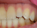 (6.) Photographs at follow up visit: all teeth asymptomatic.