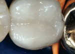 Figure 6  The buccal portion finished.