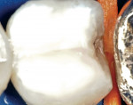 Figure 7  A Clark Class II or saucer preparation allows the composite to splint the fracture; as opposed to a traditional class II that would only further weaken the tooth. Image captured with excess light to show interproximal area.