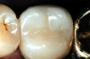 Fig 14. Dentin and enamel removed (same teeth as in Fig 13).