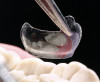 Fig 16. Lateral incisors: facial and lingual views.