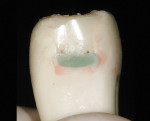 Figure 21  Wide and close-up views of the typical result of incremental loading of a Class II with a metal matrix: excessive flowable (green) with more polymerization shrinkages, a seam between the flowable and the paste, uneven finish, and a gingiva