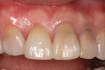(11.) 2 weeks post-op after gingival graft surgery was performed.