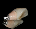 (13.) A PMMA custom provisional is fabricated over the “H” abutment to help develop ideal gingival contours.