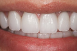 (17.) Final smile 2 weeks after cementation of lithium disilicate restorations.
