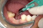 Figure 8  Splitting of the keratinized gingiva.