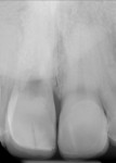 Fig 4. Periapical radiograph showed internal resorption of tooth No. 8 and possible ankylosis of the root.