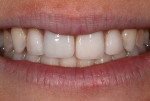 Fig 2. Patient presented with a low smile line that did not expose the recession defect from an esthetic perspective. However, she was dissatisfied with the discrepancy in tooth and incisal edge position.