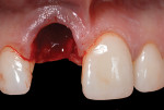 Fig 8. The palatal tissues were coronal and equivalent to the adjacent interdental tissues.