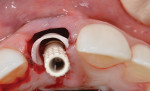 Fig 9. CAD/CAM-fabricated gingival acrylic sleeve used to construct the provisional crown restoration. It was placed in the peri-implant tissues to support them in its pre-extraction state and then joined with the implant screw-retained abutment post.