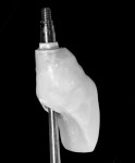 Fig 10. The provisional restoration was fabricated, properly contoured at the gingival level, and verified in the extraction socket; hence the heme visible on the acrylic material.