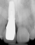 Fig 20. Periapical radiograph of the definitive restoration exhibiting adequate bone levels around the immediate implant.