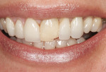 Fig 2. Lack of interdental papillae display was evident in the patient’s smile.