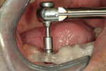 Figure 13  The #3 osteotome; note guidance of the surgical guide ring and top of the osteotome.
